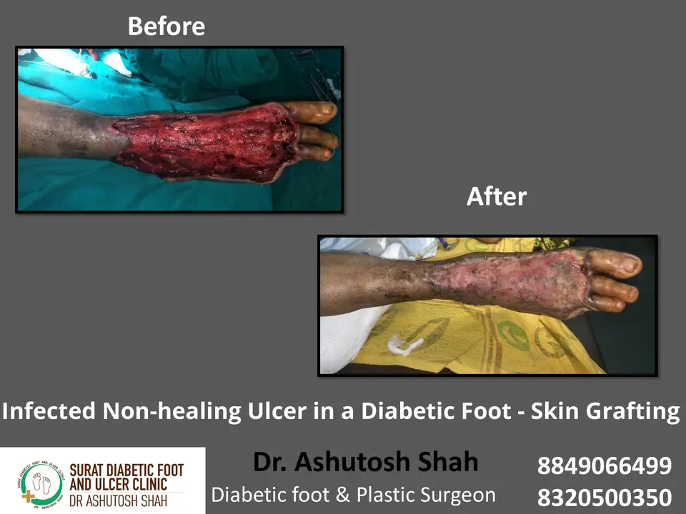 Diabetic Foot  PPT 3 checked by sir.pptx-9.webp